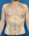Gynecomastia case #4086