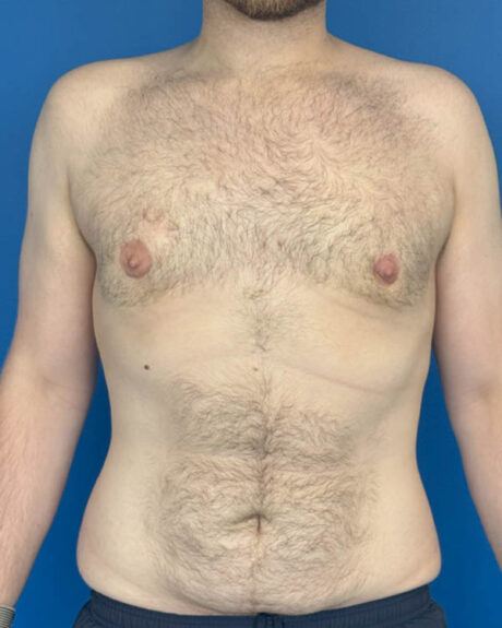Gynecomastia case #4086