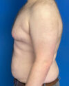 Gynecomastia case #4086