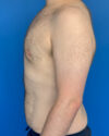 Gynecomastia case #4086