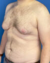 Gynecomastia case #4086