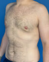 Gynecomastia case #4086