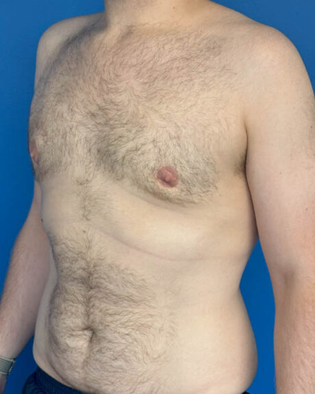 Gynecomastia case #4086