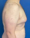 Gynecomastia case #4086