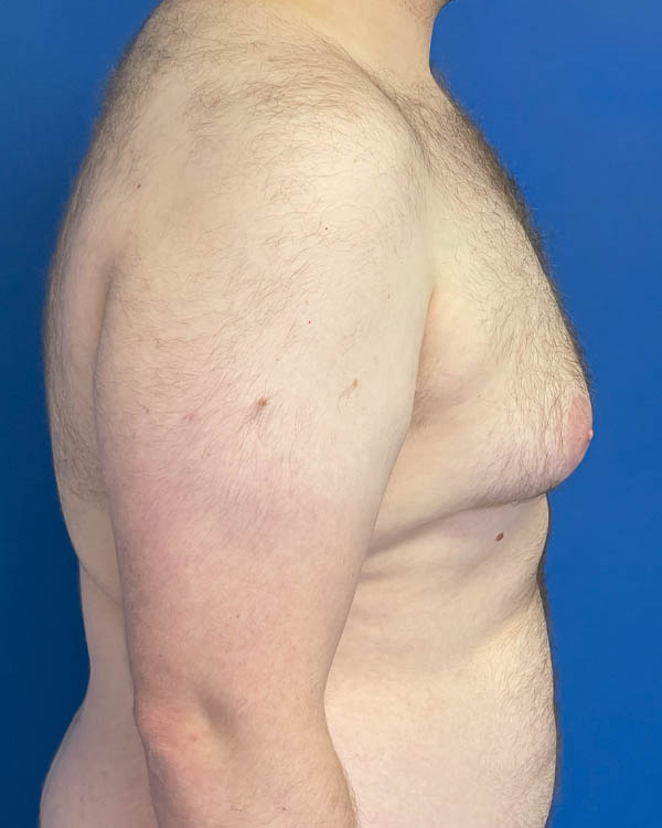 Gynecomastia case #4086