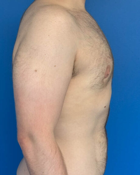 Gynecomastia case #4086