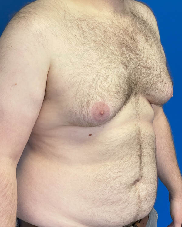 Gynecomastia case #4086
