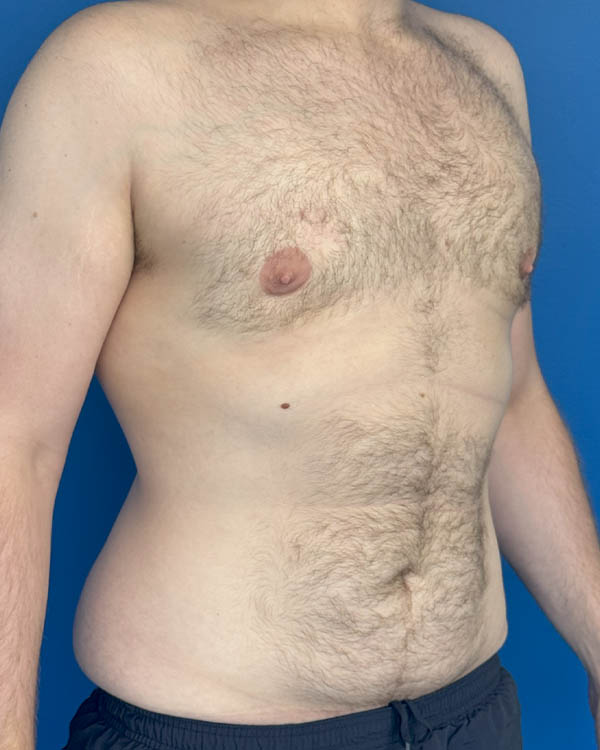 Gynecomastia case #4086