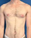 Gynecomastia case #4097
