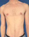 Gynecomastia case #4097