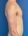 Gynecomastia case #4097