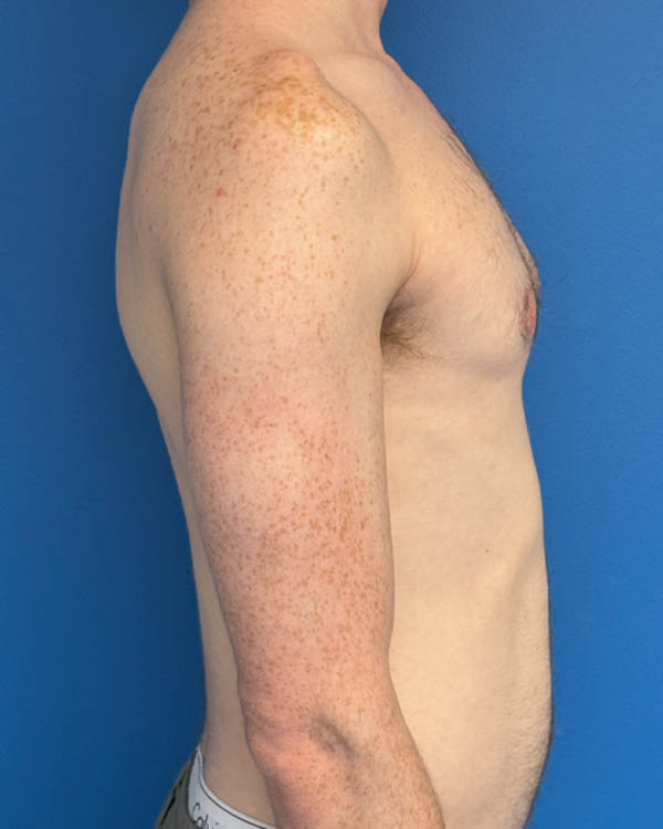 Gynecomastia case #4097