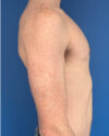 Gynecomastia case #4097