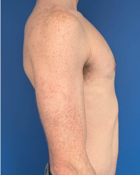 Gynecomastia case #4097