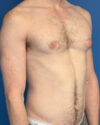 Gynecomastia case #4097