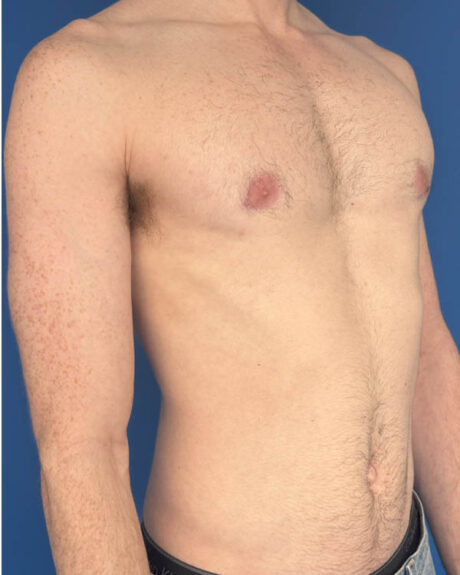 Gynecomastia case #4097