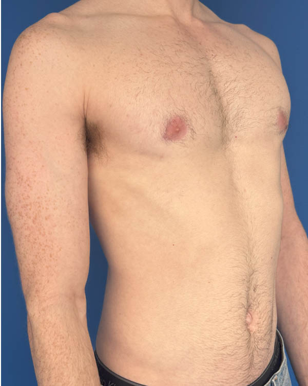 Gynecomastia case #4097