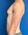 Gynecomastia case #4097