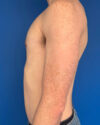Gynecomastia case #4097