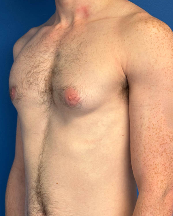 Gynecomastia case #4097
