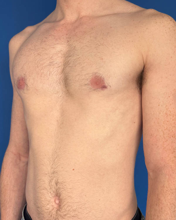 Gynecomastia case #4097