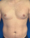 Gynecomastia case #4108