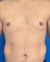 Gynecomastia case #4108