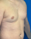 Gynecomastia case #4108