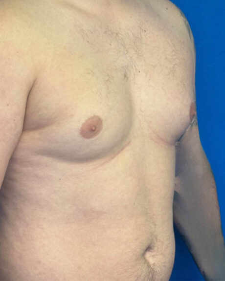 Gynecomastia case #4108