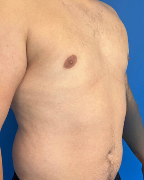 Gynecomastia case #4108