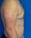 Gynecomastia case #4108