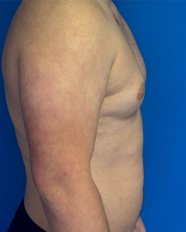 Gynecomastia case #4108