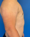 Gynecomastia case #4108