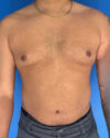 Gynecomastia case #4115