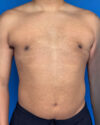Gynecomastia case #4115