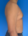 Gynecomastia case #4115
