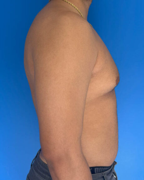 Gynecomastia case #4115