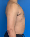 Gynecomastia case #4115