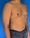 Gynecomastia case #4115