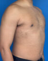 Gynecomastia case #4115
