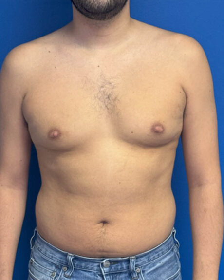 Gynecomastia case #4122