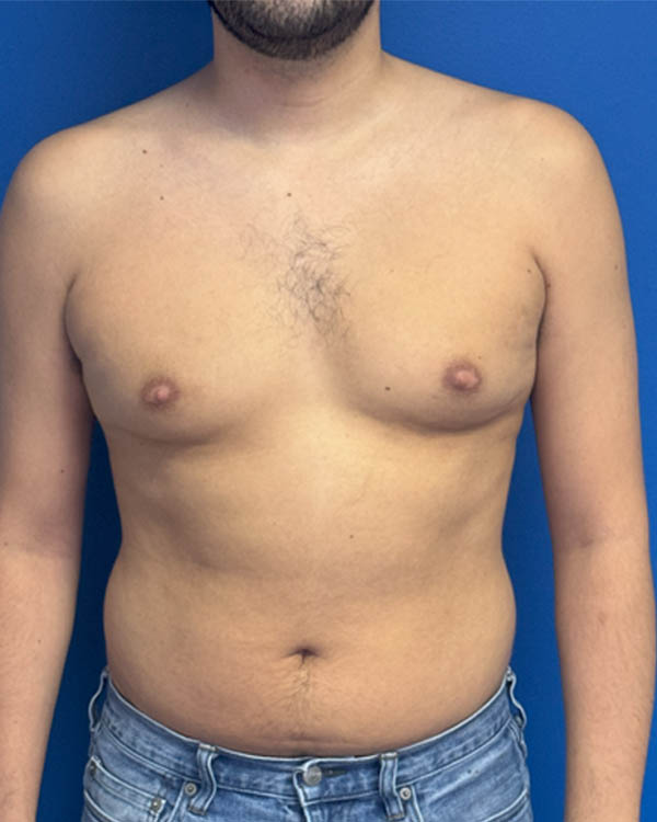 Gynecomastia case #4122