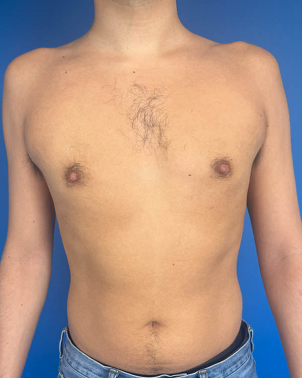 Gynecomastia case #4122