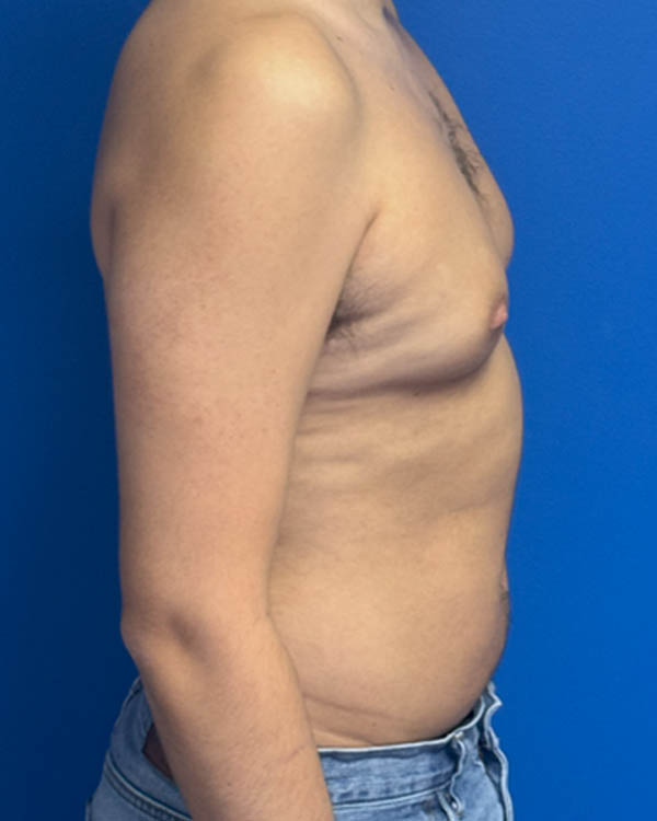 Gynecomastia case #4122