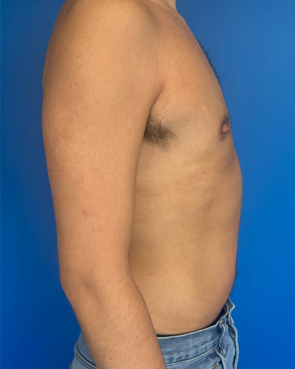 Gynecomastia case #4122