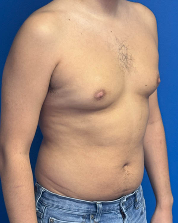 Gynecomastia case #4122