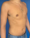 Gynecomastia case #4122