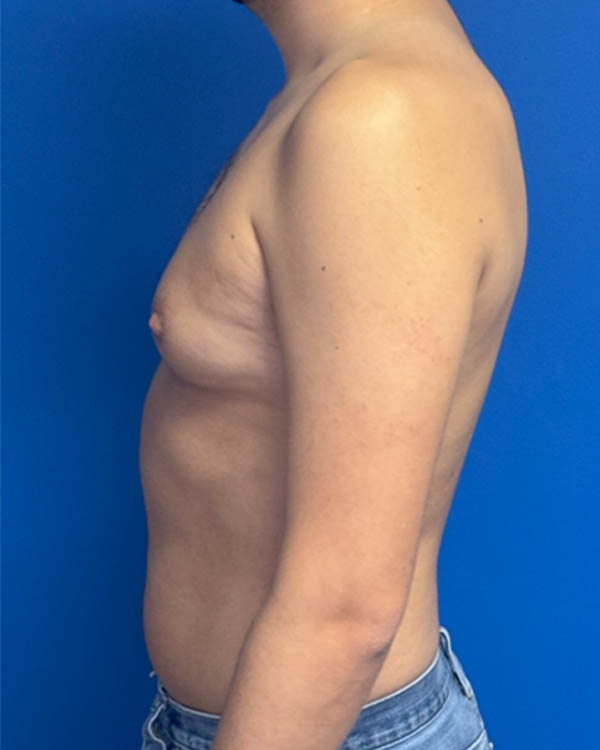 Gynecomastia case #4122