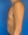 Gynecomastia case #4122