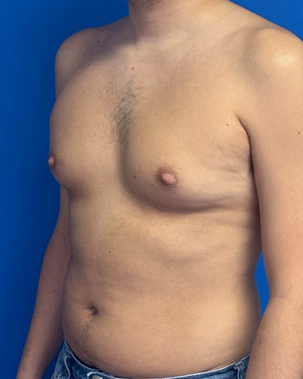 Gynecomastia case #4122
